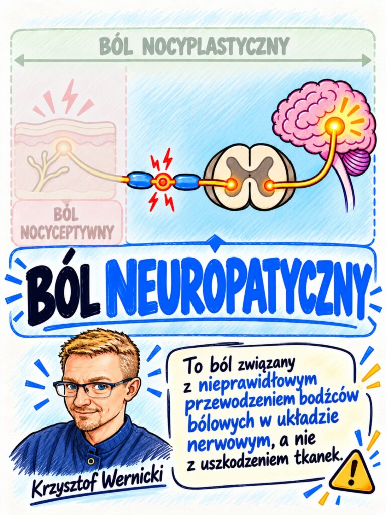 Ból neuropatyczny — schemat układu nerwowego i typowych objawów